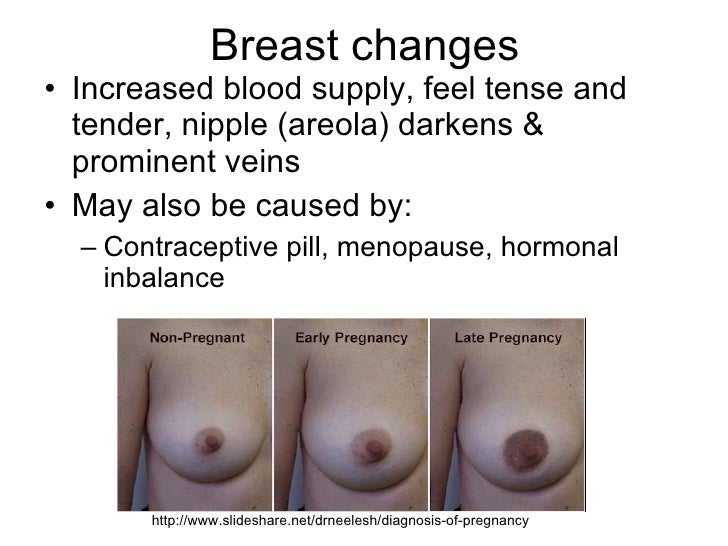 Leaking from breast in non pregnant female